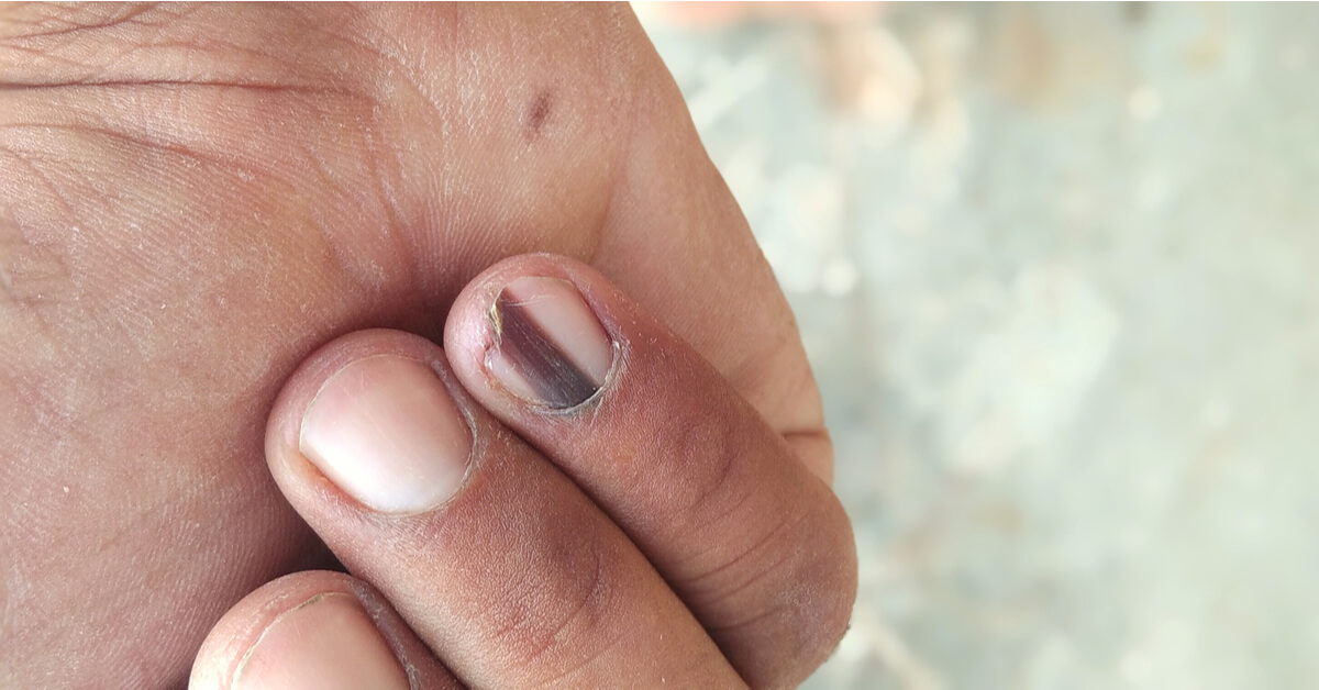 أسباب ظهور خطوط سوداء على الأظافر