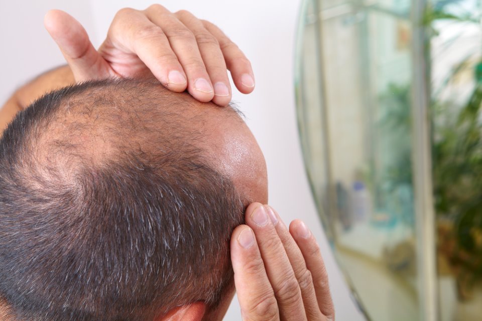 أفضل علاجات لتساقط الشعر و الصلع عند الرجال