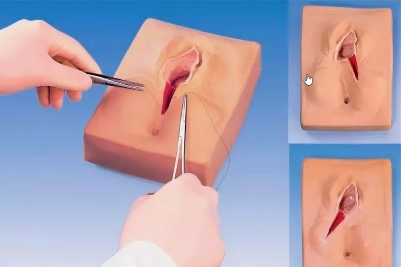 الفرق بين الخياطة التجميلية والخياطه العادية بعد الولادة